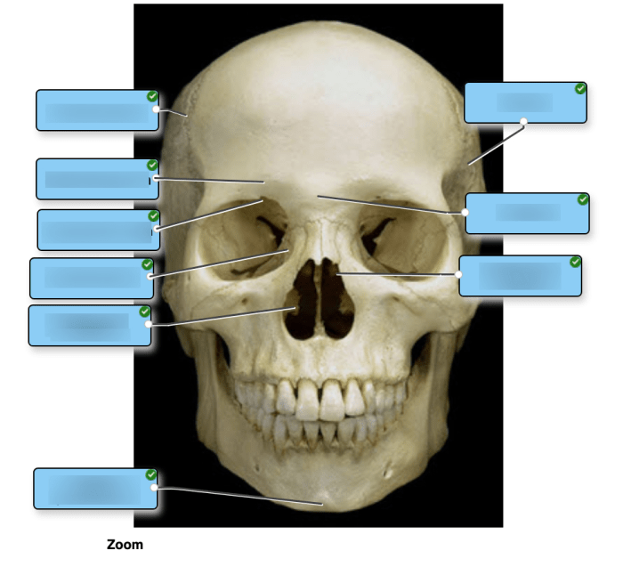 Label the specific bony features of the superior skull